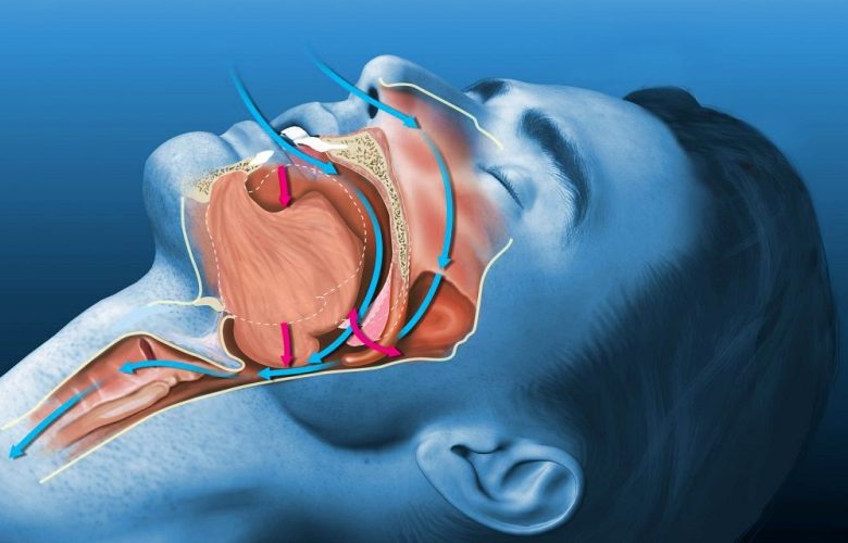 أهم الفئات المعرضة لمخاطر توقف التنفس أثناء النوم