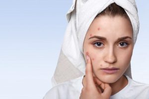 حل علاجي لحب الشباب
