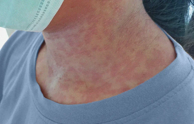 مخاطر إصابة الحامل بالحصبة الألمانية وكيف يتأثر الجنين بهذا الأمر؟