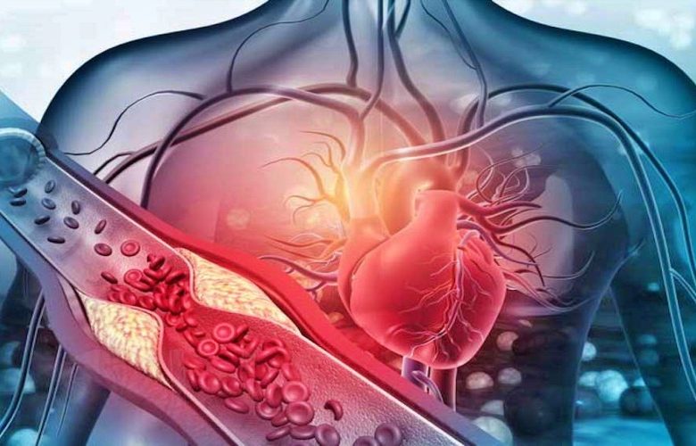 مرض الشريان التاجي.. الأسباب والمضاعفات وطرق العلاج