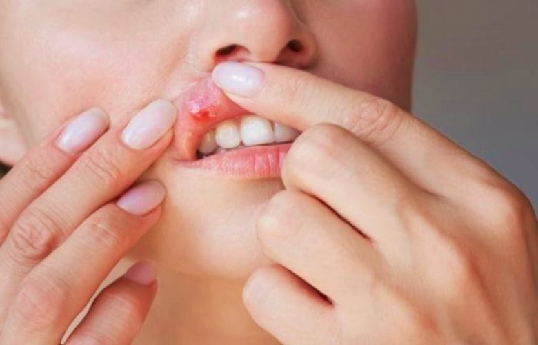 مرض بهجت وأهم أسباب حدوثه والطرق العلاجية المناسبة له مرض بهجت وأهم أسباب حدوثه والطرق العلاجية المناسبة له