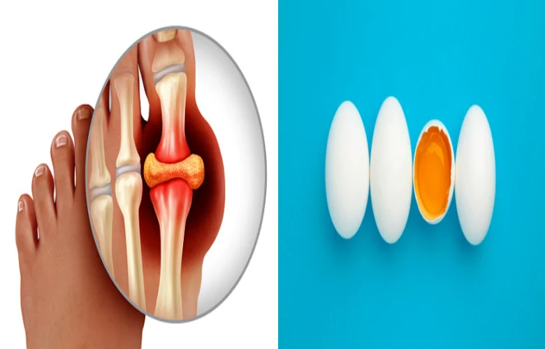 مرضى فرط حمض اليوريك وتناول البيض في السحور الرمضاني