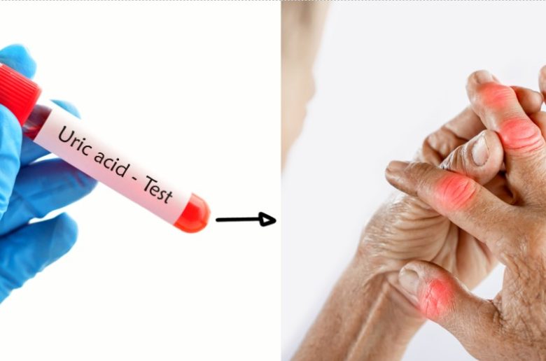 نصائح لخفض مستويات حمض اليوريك في الدم خلال شهر رمضان