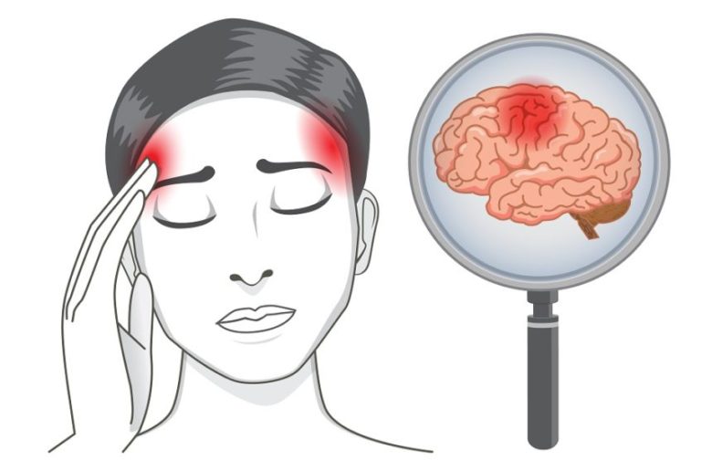 فئات نسائية أكثر عرضة للإصابة بالسكتات الدماغية