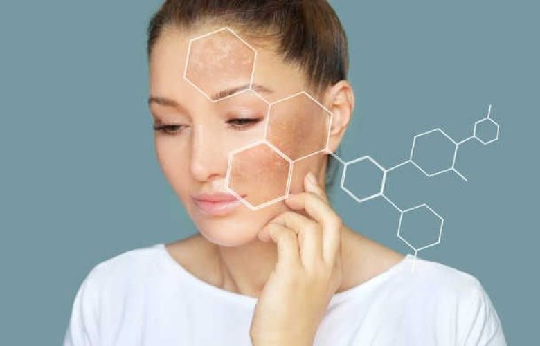 كيف نعمل على الحد من اصابة البشرة بالبقع الداكنة بعد التقشير؟ كيف نعمل على الحد من اصابة البشرة بالبقع الداكنة بعد التقشير؟