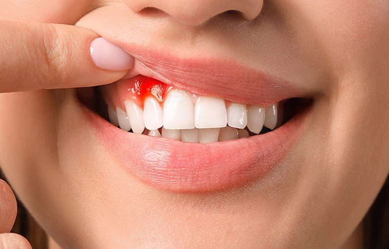 أطعمة مفيدة للوقاية من نزيف اللثة أطعمة مفيدة للوقاية من نزيف اللثة