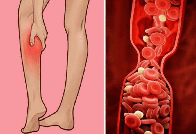 الجلطات الدموية لدى النساء
