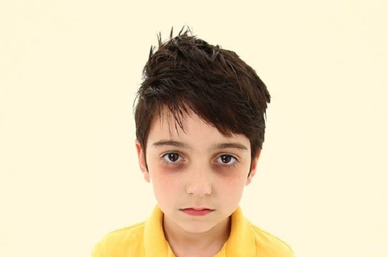 الهالات السوداء لدى الأطفال