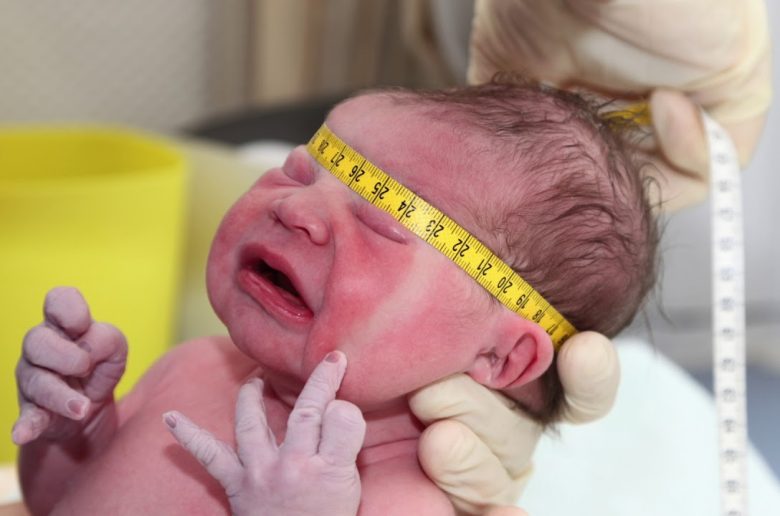تضخم رأس الطفل بعد الولادة