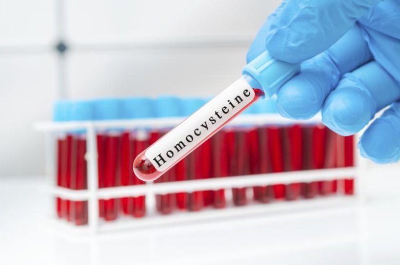 فرط الهوموسيستين في الدم