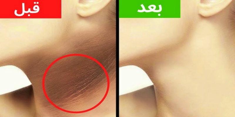 ما هي طرق علاج مرض الشواك الأسود؟
