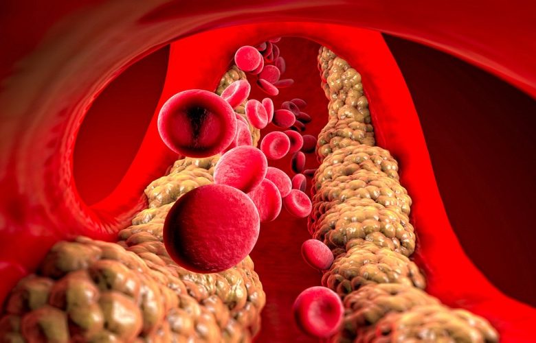 هل ارتفاع الدهون الثلاثية أمر صحي خطير؟