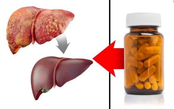 هل يحتاج مرضى الكبد الدهني إلى تناول مقويات الكبد؟ هل يحتاج مرضى الكبد الدهني إلى تناول مقويات الكبد؟