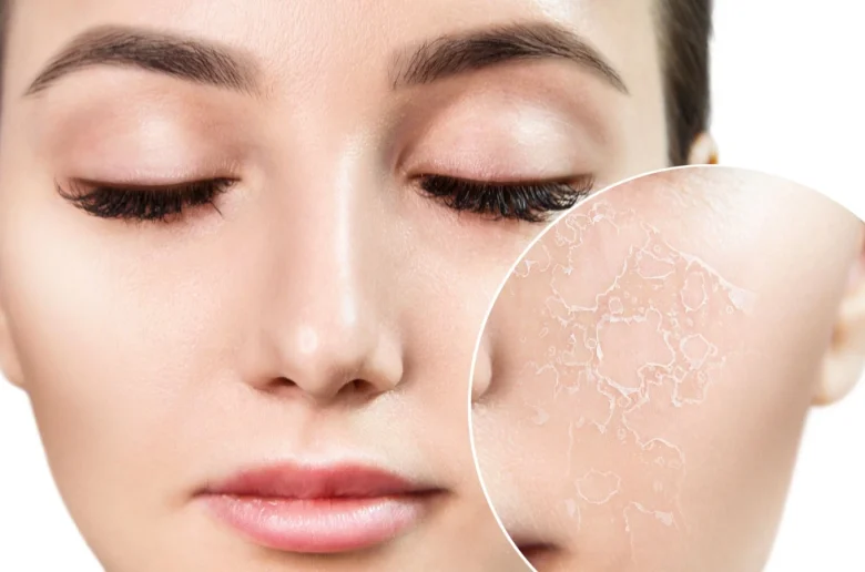أسباب جفاف البشرة الدهنية