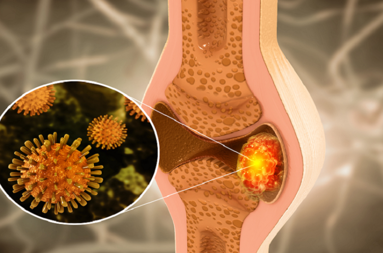 أعراض تحذيرية للكشف عن أورام العظام