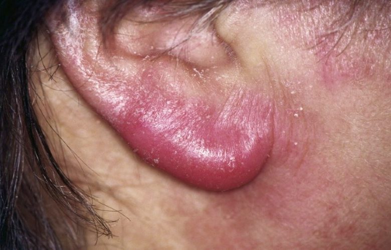 أهم الأسباب المؤدية إلى التهاب شحمة الأذن أهم الأسباب المؤدية إلى التهاب شحمة الأذن