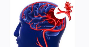 اضطرابات الأوعية الدموية في الدماغ