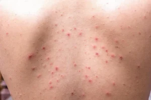 الأعراض الشائعة لطفح الكيتو