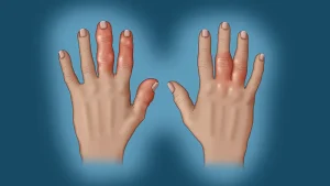 التهاب المفاصل الصدفي