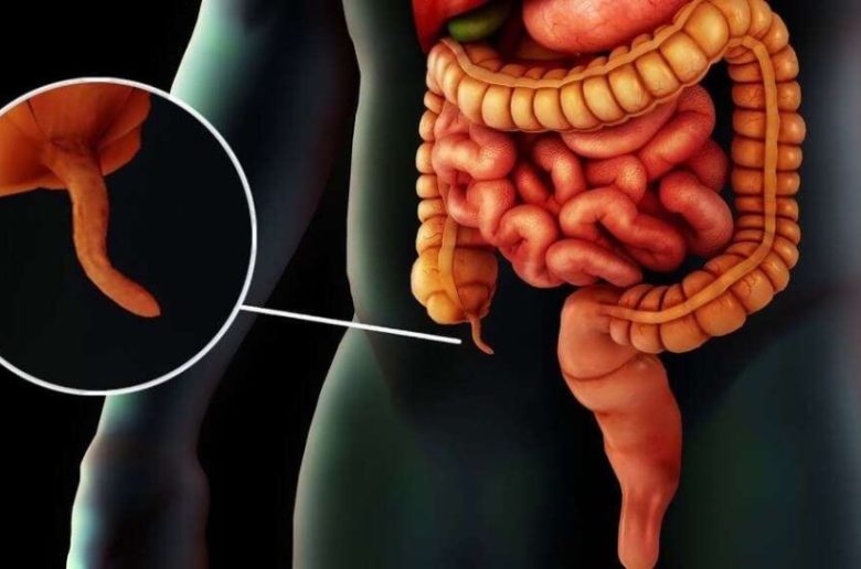 سرطان الزائدة الدودية