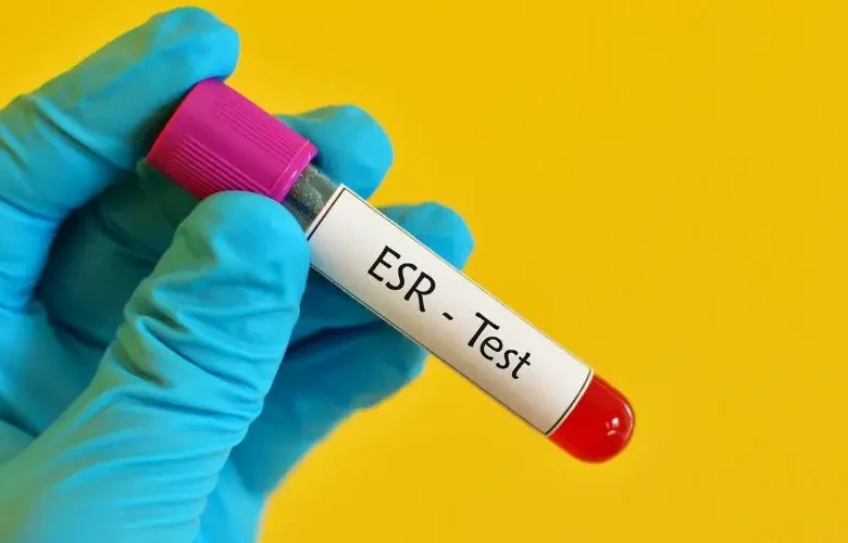 فحص سرعة الترسيب