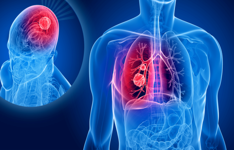 لماذا ينتقل سرطان الرئة في كثير من الأحيان إلى الدماغ؟