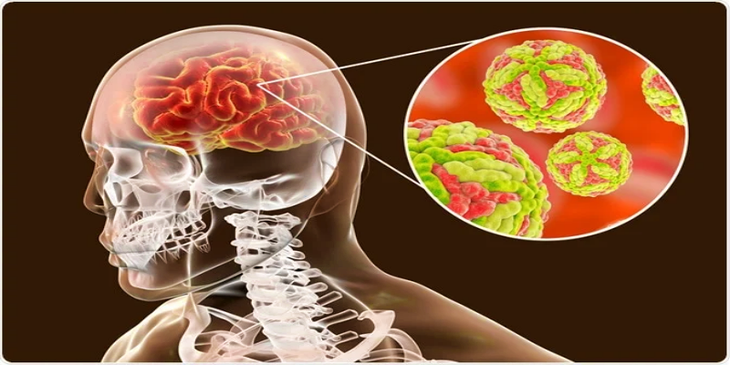 ما هي أهم العلامات النموذجية الدالة على الإصابة بالتهاب الدماغ الياباني؟