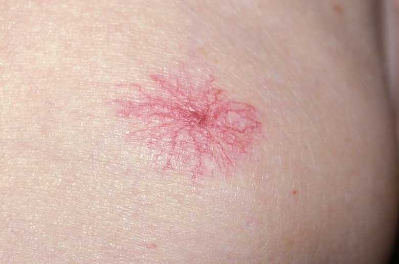 وحمة العنكبوت