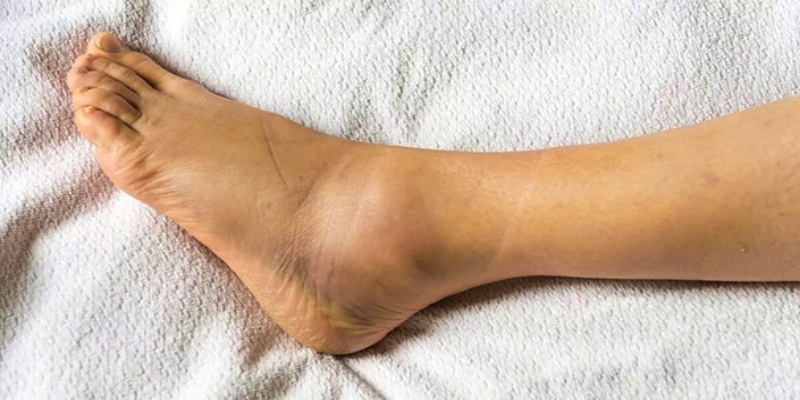 أعراض الإصابة بالتواء الكاحل