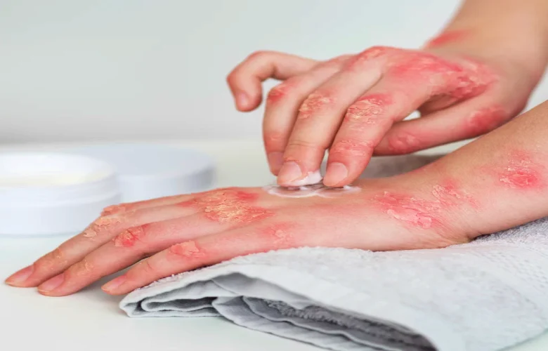 أهم الأدوية المعنية بعلاج الصدفية عند النساء