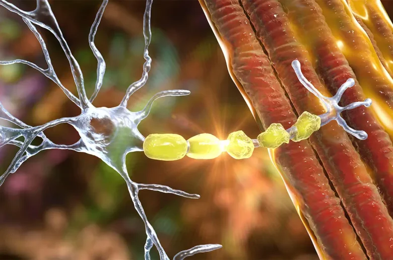 اعتلال الأعصاب الالتهابي المزمن (CIDP)