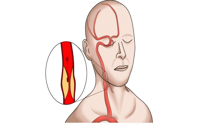 الدوخة والصداع ... احذر من تضيق الشريان السباتي
