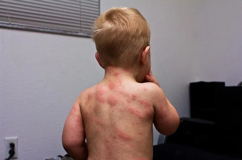 الطفح الوردي لدى الأطفال