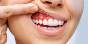 الوقاية من التهابات اللثة