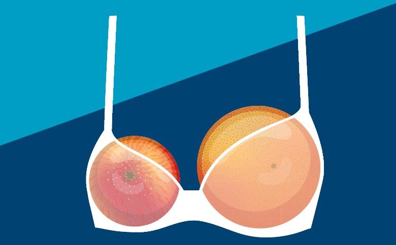 عدم تناسق حجم الثديين