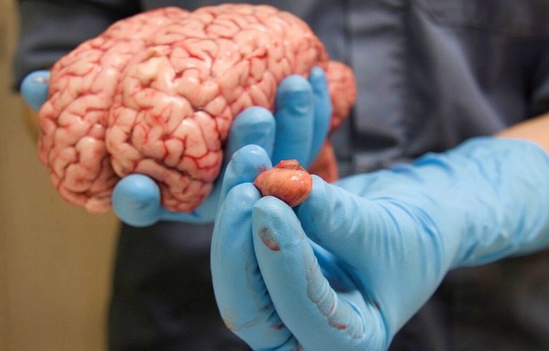 علامات تحذيرية تدل على المعاناة من قصور الغدة النخامية علامات تحذيرية تدل على المعاناة من قصور الغدة النخامية