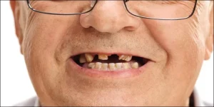 فقدان الأسنان