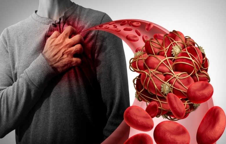 5 عادات سيئة تسبب تكون الجلطات في الأوعية الدموية