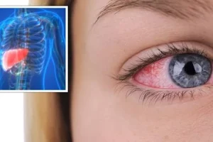 أعراض تحذيرية دالة على الكبد الدهني في العيون