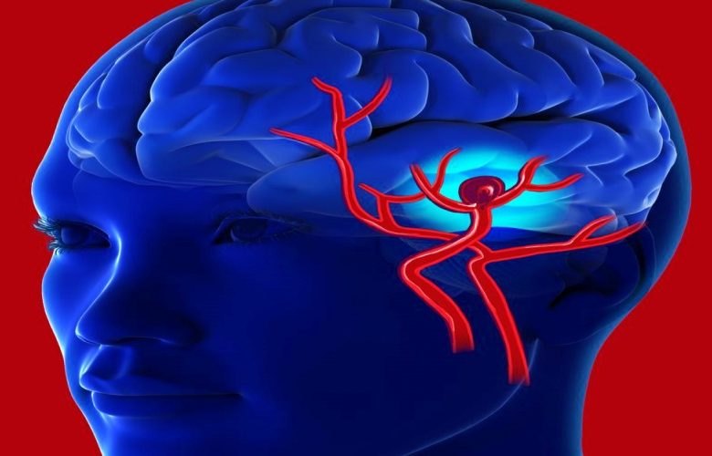 أنواع النزيف الدماغي وطرق التعرف على هذه الحالة المرضية