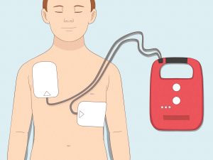 استخدام جهاز مزيل الرجفان