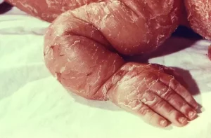 الأعراض الشائعة لمرض السمك الجلدي