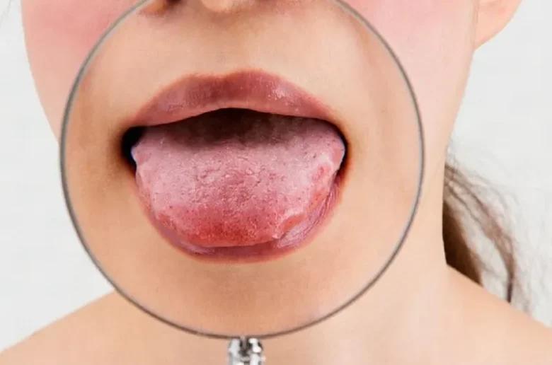 التهاب الحليمات اللسانية