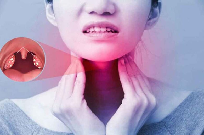 التهاب اللوزتين الصديدي المعدي التهاب اللوزتين الصديدي المعدي