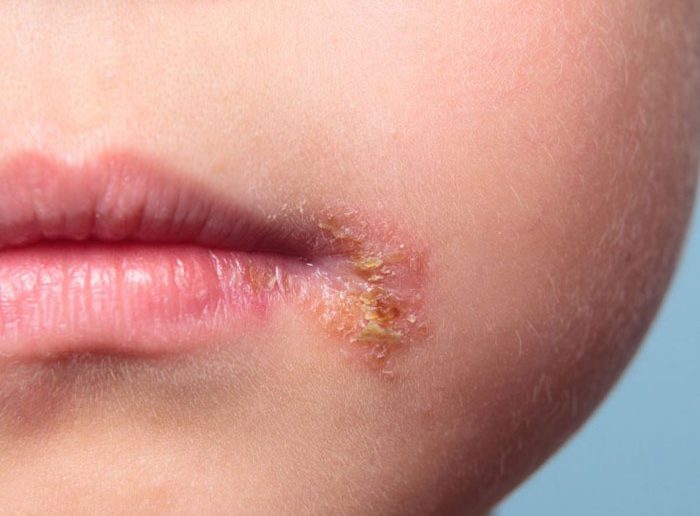 التهاب زوايا الشفاة التهاب زوايا الشفاة