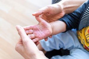الفئات الأكثر عرضة للمعاناة من متلازمة الجلد المحروق