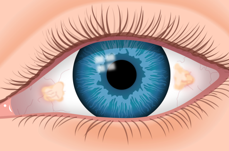 بقع بيتو بقع بيتو في العيون