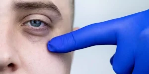 تورم المنطقة المحيطة بالعين