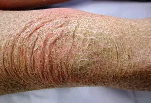 داء السمك الصفائحي