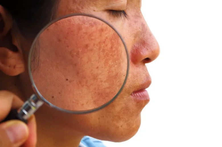 طرق علاجية للبقع الداكنة لدى المصابات بتكيس المبايض